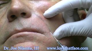 Nasolabial Fold Filler with Cannula by Dr Joe Niamtu [upl. by Checani]