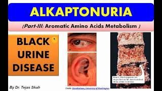 Alkaptonuria II Inborn error of aromatic amino acid metabolism II Biochemistry II Dr Tejas Shah [upl. by Anemix]