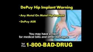 Depuy Hip Replacement Claims [upl. by Clorinda]