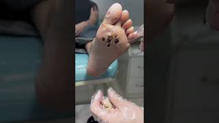 Treatment Callus and Dead skin Ep13  Sheng Clinic [upl. by Ralat]