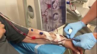 Dialysis connection of a patient with an arteriovenous fistula [upl. by Ibloc237]