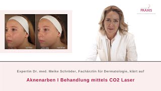 Aknenarben I Behandlung mittels CO2 Laser I Spezialistin Dr med Meike Schröder klärt auf ✅ [upl. by Gaal870]