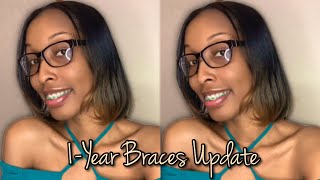 1 Year Braces Update  24hr Wear Elastic Rubber Bands  Powerchain Update  Overall Journey Thus Far [upl. by Raleigh]