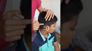 Introduction of cochlear implants [upl. by Ashbaugh]