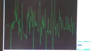 Myopathy EMG changes explained [upl. by Enialed]