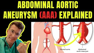 Doctor explains ABDOMINAL AORTIC ANEURYSM AAA  Symptoms risk factors treatment screening [upl. by Eilema]