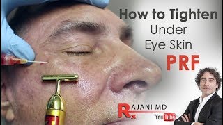 How to Tighten and Brighten the Under EyeDr Rajani Style Aesthetics Portland [upl. by Abita466]