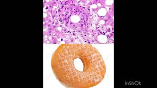 Doughnut Granulomas AKA Fibrin Ring Granulomas are seen in Q Fever [upl. by Herwin]