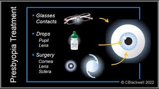 Presbyopia 4 Summary of Why We Need Reading Glasses and New Alternatives [upl. by Elaynad603]