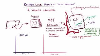 Benign liver tumors causes symptoms diagnosis treatment amp pathology [upl. by Cogn]