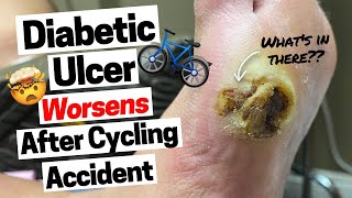 This Is What Happens To Diabetic Ulcers After an Accident [upl. by Kiryt]