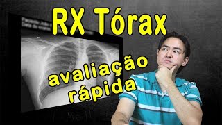 Raio X Tórax  Avaliação rápida [upl. by Abagael]