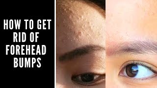 How to Get Rid of Forehead Bumps [upl. by Alac]