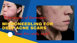 【1st session】microneedling at home using dermapen M8  Does microneedling work for acne scars DEMO [upl. by Fairley]