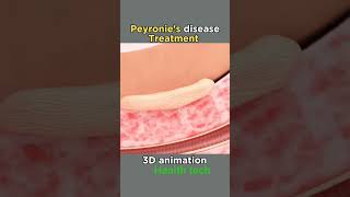 Peyronies disease treatment health biology peyroniesdisease humanbody [upl. by Goodrich]