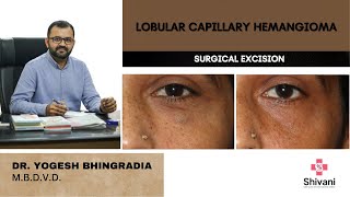 LOBULAR CAPILLARY HAEMANGIOMA  SURGICAL EXCISION  DR YOGESH BHINGRADIA [upl. by Dogs]