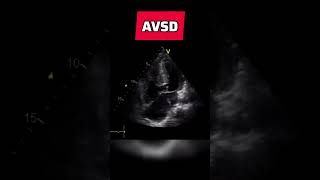 Atrioventricular septal defect  congenital heart defect echocardiography AVSD [upl. by Neelahs193]