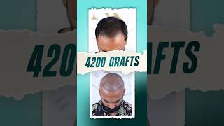 Hair Transplant in Bangladesh 4200 grafts hairtransplant bangladesh hair shorts [upl. by Fineman]