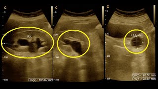 Grade  3  Hydroureteronephrosis  Ultrasound  Report  Amader hospital  Ultrasonography report [upl. by Nemlaz127]