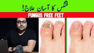 Dr ZeeGet Rid Of Toenail Fungus A complete guide [upl. by Lennaj]