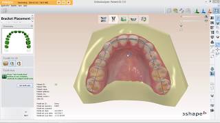 How to Do a Model Segmentation for Brackets Placement in 3Shape [upl. by Teteak]