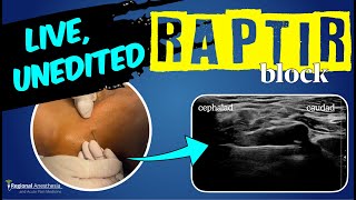 RAPTIR block start to finish Retroclavicular Approach to the Infraclavicular Region [upl. by Bartie]