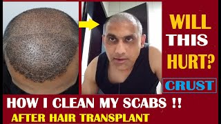 How To Remove Scabs amp Heal Donor Area After Hair Transplant Surgery [upl. by Akins]