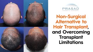 How a NonSurgical Hair Transplant Alternative can Overcome Limitations of Hair Transplants [upl. by Olsen]