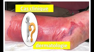 Cas clinique quotdermatologie quot [upl. by Analed]