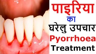 पायरिया के घरेलू उपाय और नुस्खे  Natural Home Remedies amp Treatment for Pyorrhea [upl. by Eelloh482]