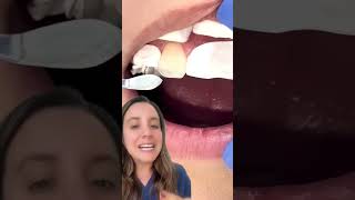 Mejora tu sonrisa con resinas en bordes incisales sin desgastar tus dientes 🦷 [upl. by Oileve]