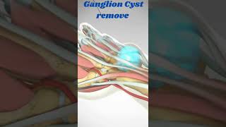 Ganglion Cyst remove viral ganglioncystbiology3danimation crazypharmaguruji1331 [upl. by Ailatan]