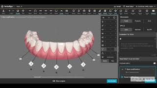 When tip is better than torque in your aligner finishes [upl. by Chrysler512]