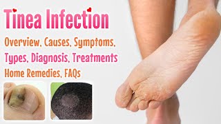 Tinea overview causes sign and symptoms diagnosis treatment home remedies and FAQs [upl. by Noyr]