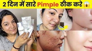 My Oily Acne Prone Skincare Routine 2024  Get Rid Of Pimples In Just 2 Days 😱 [upl. by Ahgiel]