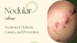 Nodular Acne  Pimples treatment  Chemical Peels  IPL Laser [upl. by Arezzini]