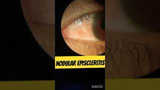 Nodular Episcleritis nodularepiscleritis eyediseases [upl. by Hekking]