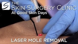 Laser Mole Removal  Watch the Procedure [upl. by Rusert642]