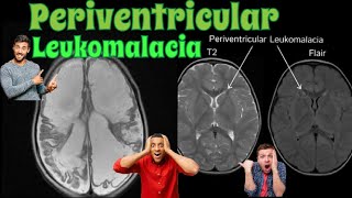 Periventricular Leukomalacia  MRI BRAIN 🧠 [upl. by Johny]