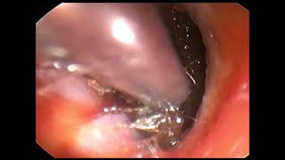 Gros bouchon de cérumen earwax removal JB DANVIN 3 [upl. by Veta]