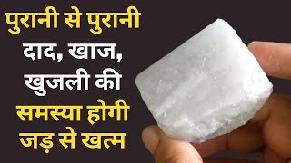 दाद खाज खुजली को जड़ से खत्म करने का 100 घरेलू उपाय  Natural way to get rid of itching  Khujli [upl. by Gmur]