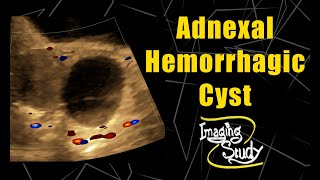 Adnexal Hemorrhagic Cyst  Ultrasound  Case 63 [upl. by Llerat]