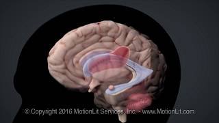 Intracerebral Hemorrhage Stroke [upl. by Nniuq]