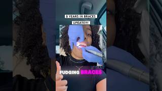 Braces Update  Braces Vlog 2024 shortsfeed braces ortho [upl. by Novek]