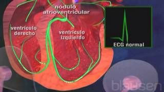 ¿Por qué se produce la taquicardia ventricular [upl. by Mas]