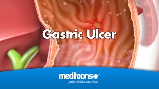 Gastric Ulcer  Meditoons™ [upl. by Konstance]