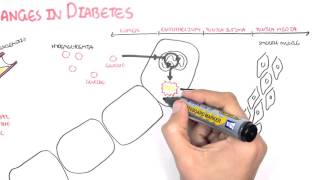 Diabetes Complication and Pathophysiology of the complication [upl. by Tteve]