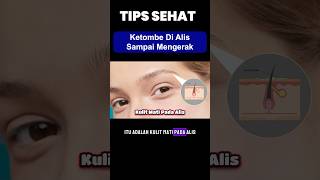 Ketombe Dialis ini Penyebabnya ketombe ketombealis tipssehat dermawell drsaddamismail [upl. by Yartnod]