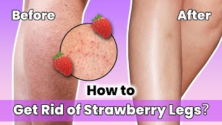 How to Get Rid of Strawberry Legs？Skincare Strawberryskin rxmoore [upl. by Brande]