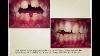 Interceptive orthodontics 1 [upl. by Taam]